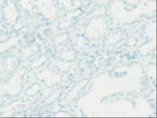 肺癌患者ALK蛋白表达的首款全自动免疫组化(