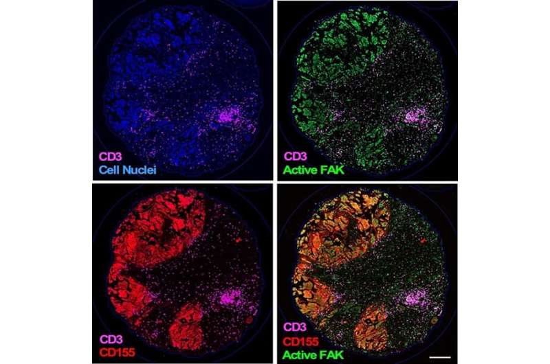 How ovarian cancer defies immunotherapy