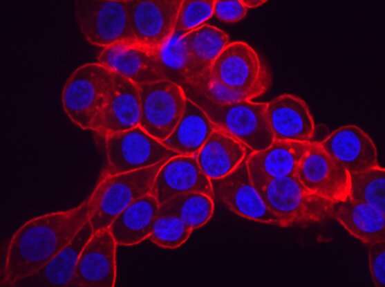 Researchers find genetic Achilles heel in ovarian and uterine cancers