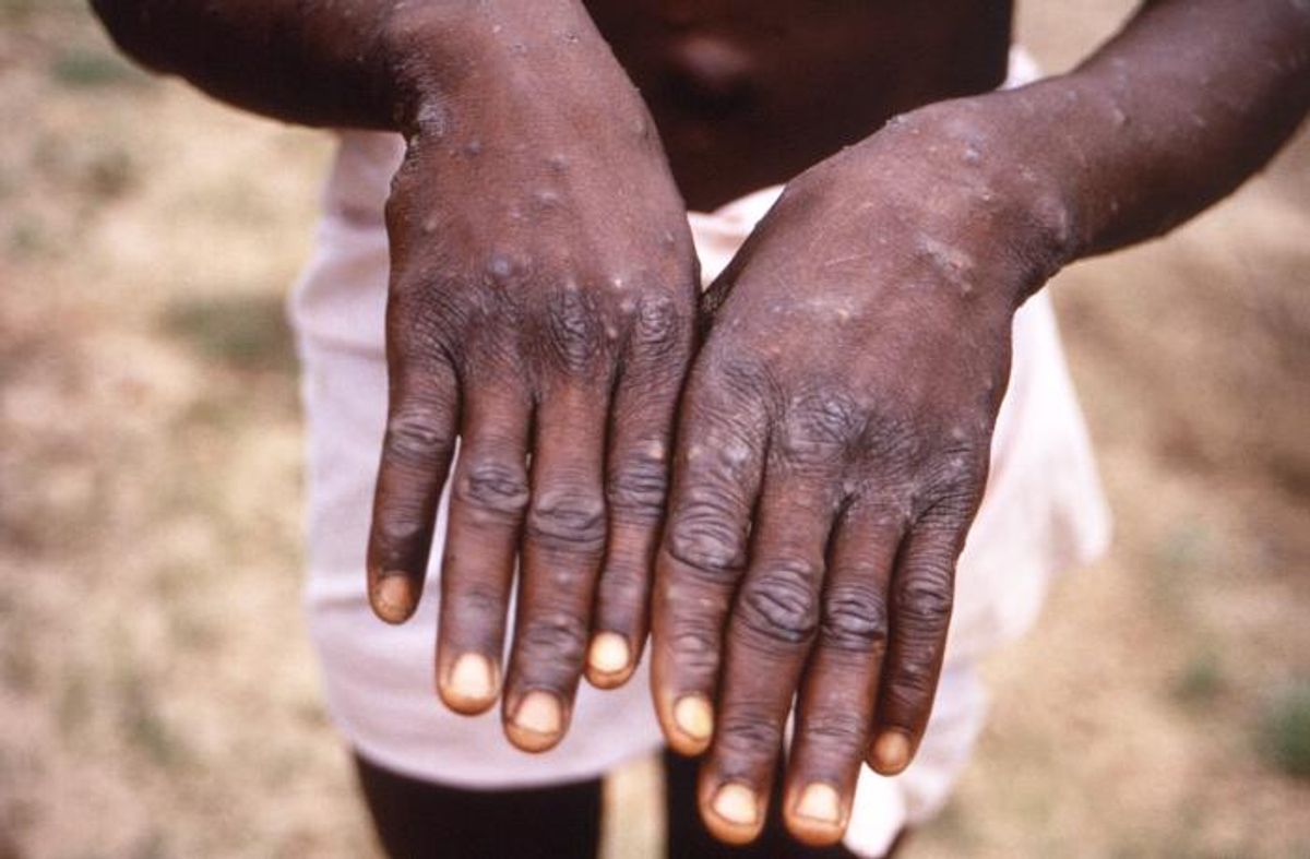 Monkeypox rash on hands