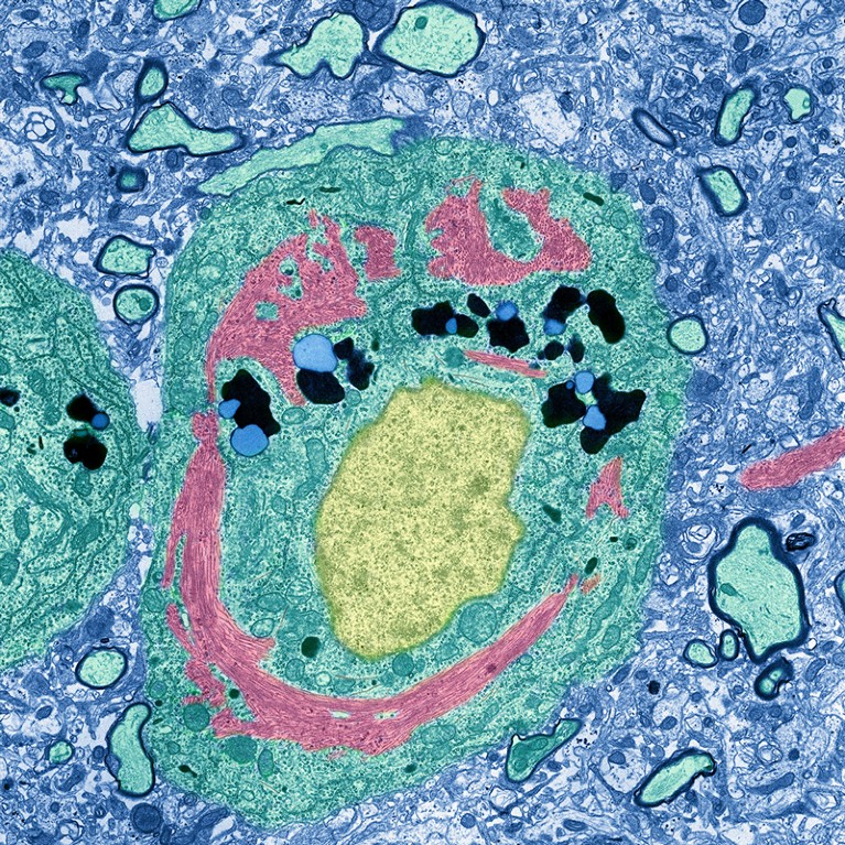 Neuron in Alzheimer��s disease, coloured transmission electron micrograph.