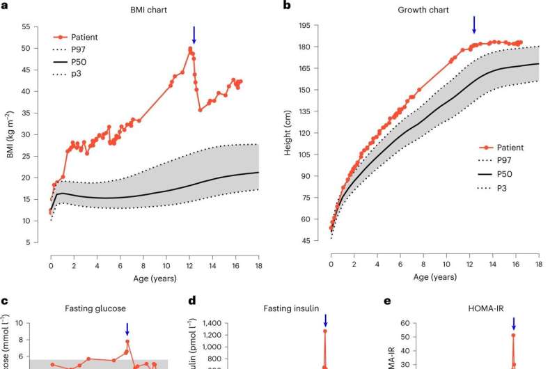 Obesity researchers discover new gene mutation in children